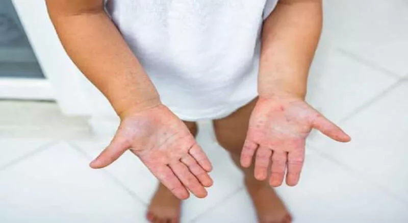 Descarta Tamaulipas alerta epidemiológica por casos de Mano-Pie-Boca